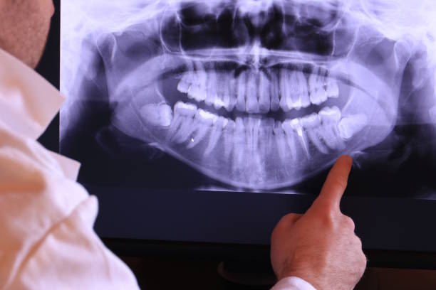Best Emergency Wisdom Tooth Extraction in Bethany, MO